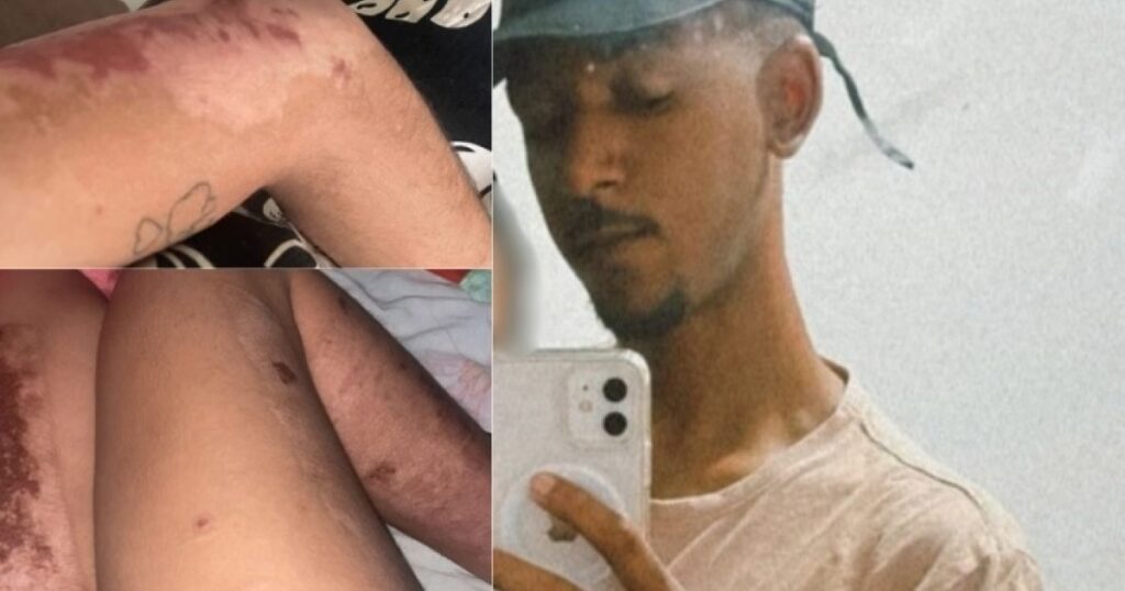 Após 9 meses, jovem conta como teve corpo incendiado pelo marido na Bahia e acusa tentativa de feminicídio