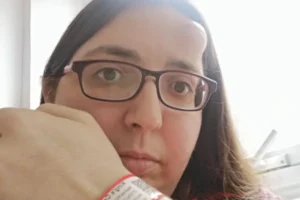 Caroço na testa levou a mulher a descobrir mieloma e perfuração no crânio