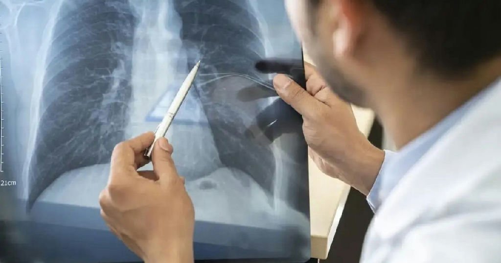 Anvisa autoriza novo remédio para tratamento de câncer de pulmão avançado
