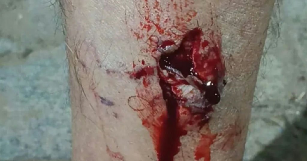 Ataque de matilha deixa homem ferido em Livramento de Nossa Senhora