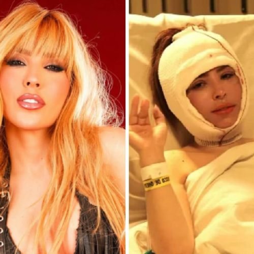 Cantora Manu Bahtidão mostra resultado de cirurgia plástica no rosto