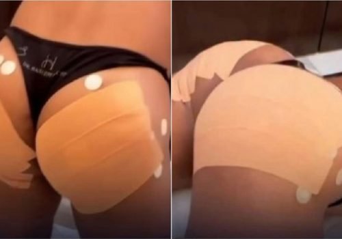 Homens buscam procedimentos estéticos para contorno de glúteos e movimentam clínicas