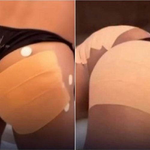 Homens buscam procedimentos estéticos para contorno de glúteos e movimentam clínicas